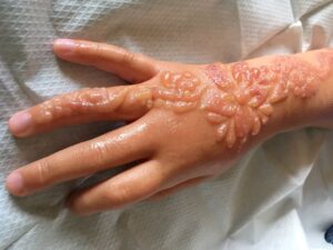 Queimadura por tatuagem de Henna