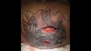 tatuagem infeccionada morte sepse tattoopediabr 3