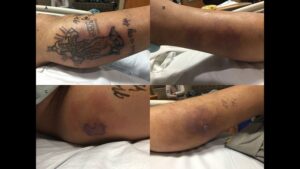 tatuagem infeccionada morte sepse tattoopediabr 7
